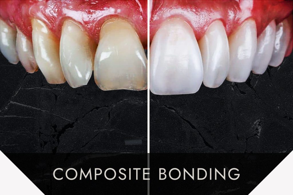 Before and after comparison of yellowed, chipped teeth vs clean white teeth fixed by composite bonding