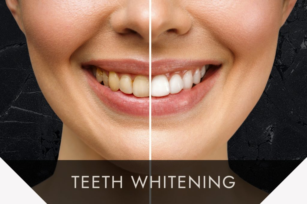 Teeth whitening treatment before and after comparison